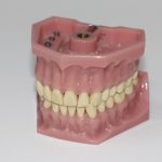 Best Denture Adhesive for Lower Dentures